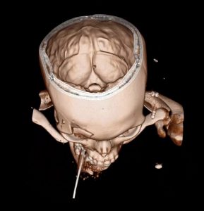 A 3-D rendering of a skull, “virtually” sliced open on the anatomy visualization table.